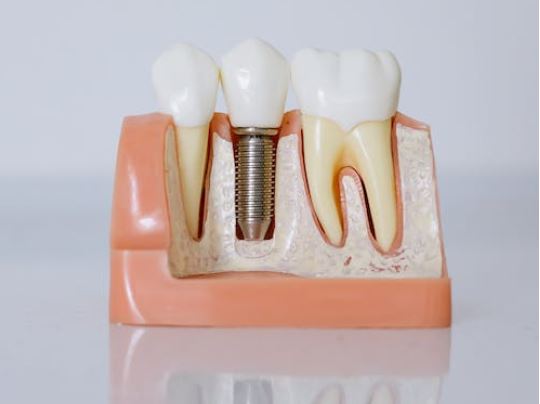 Finding the perfect expense meant for teeth implants during houston